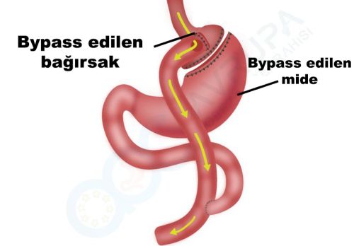 Gastrik Bypass Nedir