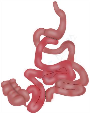 Transit Bipartition (Type 2 Diabetic Surgery)