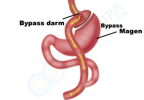 Was ist ein Gastrischer Bypass (Magenbypass)