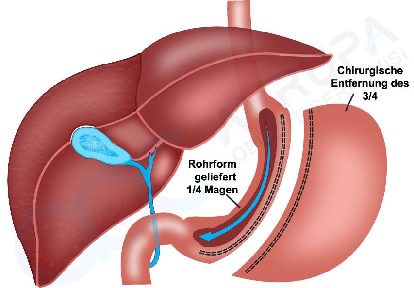 Was ist eine Schlauchmagen (Magenverkleinerung) Operation