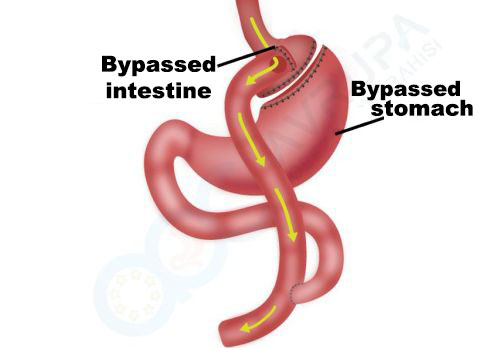 What is Gastric Bypass