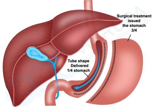 What is Stomach Tube Surgery